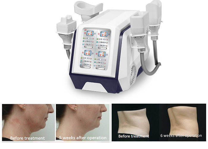 Yağ Yakma Kilo Kaybı İçin Taşınabilir 360 Cryolipolysis Vücut Zayıflama Makinesi 1000W
